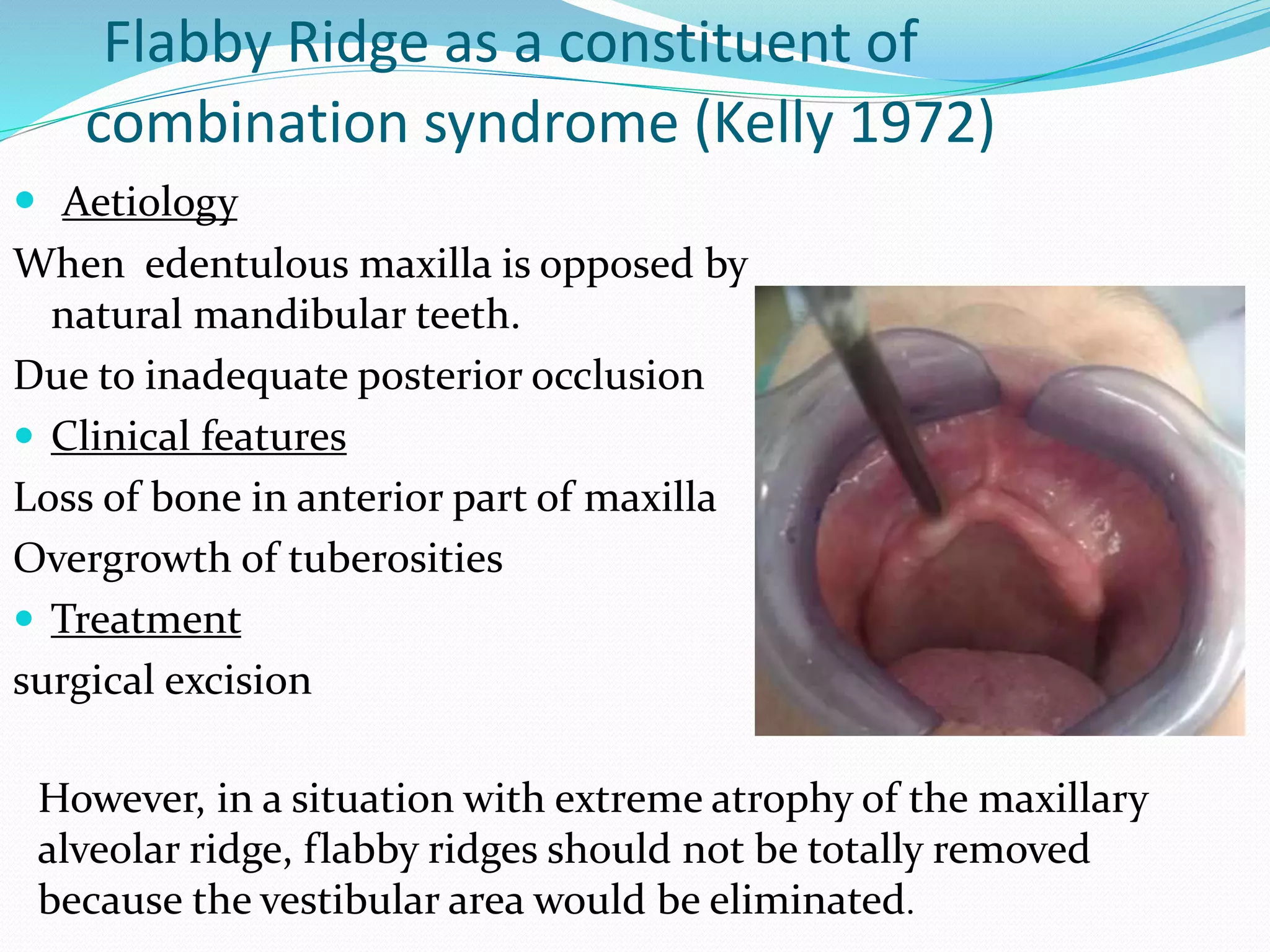 Flabby Ridge Radiograph Sequelae of wearing complete denture | PPTX