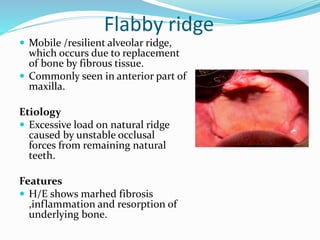 Flaring Ridge Defect Sequelae of wearing complete denture | PPTX