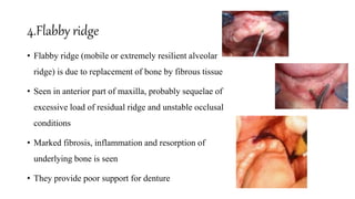 Tissue Ridges SEQUELAE OF WEARING COMPLETE DENTURE.pptx