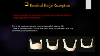 sequelae of wearing complete denture.pptx