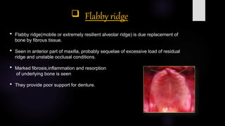 Flaring Ridge Defect sequelae of wearing complete denture.pptx