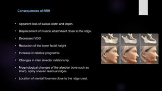 Sharp Spiny Ridge sequelae of wearing complete denture.pptx