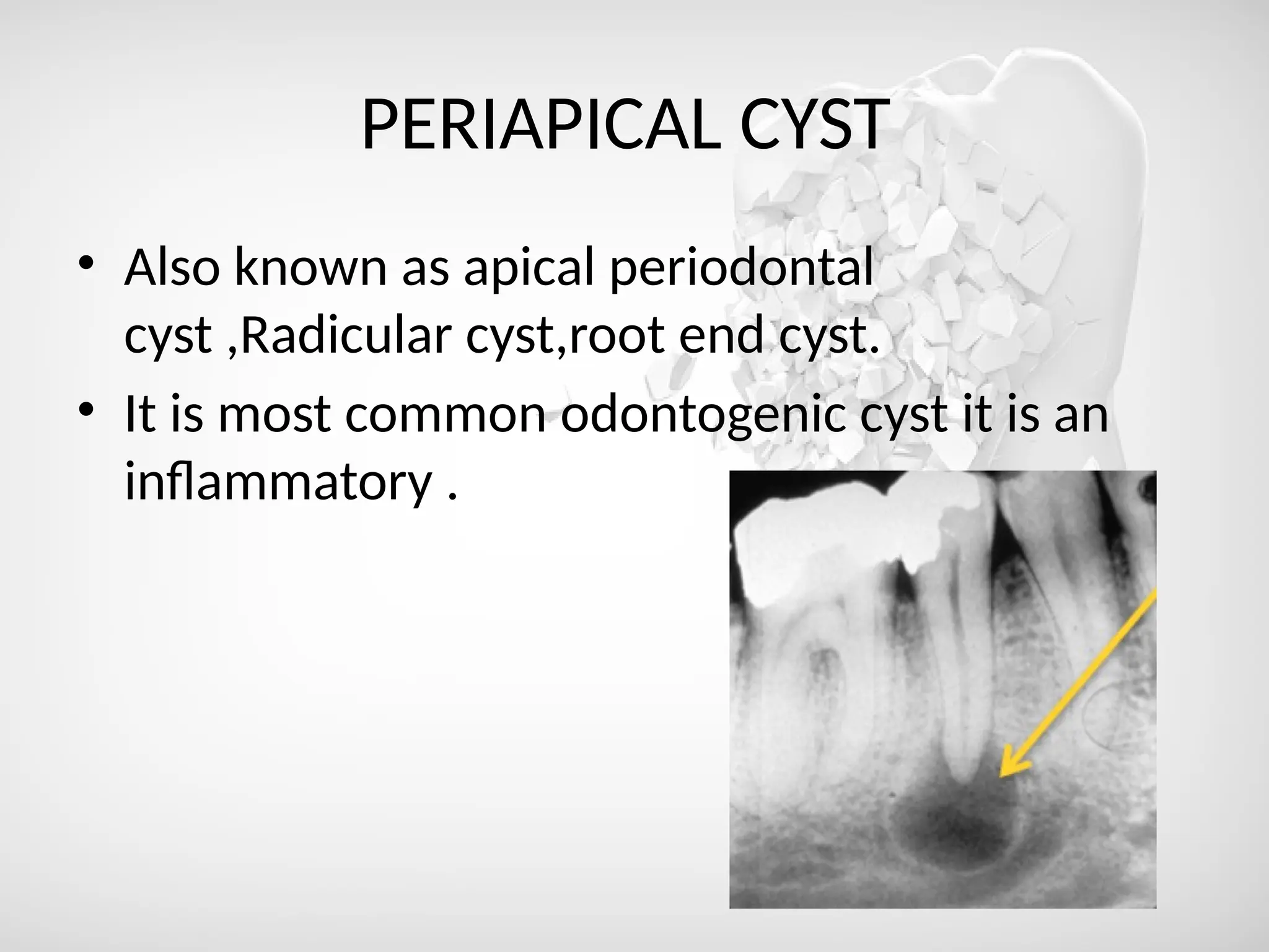 PERIAPICAL CYST
• Also known as apical periodontal
cyst ,Radicular cyst,root end cyst.
• It is most common odontogenic cyst it is an
inflammatory .
 