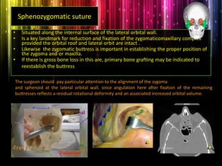 Sphenozygomatic suture
• Situated along the internal surface of the lateral orbital wall.
• Is a key landmark for reduction and fixation of the zygomaticomaxillary complex
provided the orbital roof and lateral orbit are intact .
• Likewise the zygomatic buttress is important in establishing the proper position of
the zygoma and or maxilla.
• If there is gross bone loss in this are, primary bone grafting may be indicated to
reestablish the buttress.
The surgeon should pay particular attention to the alignment of the zygoma
and sphenoid at the lateral orbital wall, since angulation here after fixation of the remaining
buttresses reflects a residual rotational deformity and an associated increased orbital volume.
 