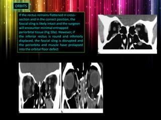 If the rectus remains flattened in cross-
section and in the correct position, the
fascial sling is likely intact and the surgeon
will encounter minimal entrapped
periorbital tissue (Fig 10a). However, if
the inferior rectus is round and inferiorly
displaced, the fascial sling is disrupted and
the periorbita and muscle have prolapsed
into the orbital floor defect
ORBITS
 