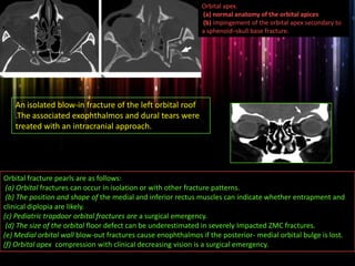Orbital apex.
(a) normal anatomy of the orbital apices
(b) impingement of the orbital apex secondary to
a sphenoid–skull base fracture.
An isolated blow-in fracture of the left orbital roof
.The associated exophthalmos and dural tears were
treated with an intracranial approach.
Orbital fracture pearls are as follows:
(a) Orbital fractures can occur in isolation or with other fracture patterns.
(b) The position and shape of the medial and inferior rectus muscles can indicate whether entrapment and
clinical diplopia are likely.
(c) Pediatric trapdoor orbital fractures are a surgical emergency.
(d) The size of the orbital floor defect can be underestimated in severely Impacted ZMC fractures.
(e) Medial orbital wall blow-out fractures cause enophthalmos if the posterior- medial orbital bulge is lost.
(f) Orbital apex compression with clinical decreasing vision is a surgical emergency.
 