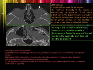 ZMC fractures
a displaced fracture of the left zygoma.
The rotational deformity of the zygoma is
demonstrated by angulation of the lateral
orbital wall at the zygomaticosphenoid suture.
The lateral displacement (black arrow) of the
lateral vertical buttress (*) has resulted in
increased orbital volume and enophthalmos
As long as the rotational deformity is
corrected and the other maxillary
buttresses are fixated by means of limited
incisions, the zygomatic arch does not
need to be exposed
ZMC fracture pearls are as follows:
(a) The ZMC relates to the temporal bone, maxilla, frontal bone, and skull base and is therefore a quadripod
structure.
(b) Displaced ZMC fractures often increase orbital volume by angulation of the lateral orbital wall at the
zygomaticosphenoid suture or blow-out of the orbital floor.
(c) The zygomatic arch establishes both facial width and profile. Surgical exposure is indicated if it is severely
comminuted or angulated.
 