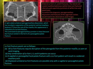 Bilateral Le Fort I, II, and III fractures. The lateral and
medial maxillary buttresses (white lines) are fractured
inferiorly and superiorly (junctions of white lines and
black lines).
To confirm the diagnosis, pterygomaxillary
disjunction and fractures of the zygomatic arches
would need to be observed on axial images.
A right-sided unilateral pterygomaxillary disjunction, which
has resulted in separation of the posterior vertical maxillary
buttress (*) from the rest of the maxilla; this appearance is
indicative of a Le Fort fracture.
The contralateral pterygomaxillary junction is intact because
the fracture exited in the form of a parasagittal palate
fracture
Le Fort fracture pearls are as follows:
(a) All Le Fort fractures require disruption of the pterygoids from the posterior maxilla, as seen at
axial imaging.
(b) Any combination of Le Fort I, II, and III patterns can occur.
(c) A sagittal or parasagittal hard palate fracture with a Le Fort pattern will result in a widened
maxillary arch.
(d) Displaced unilateral Le Fort fractures are possible only with a sagittal or parasagittal palate
fracture.
 