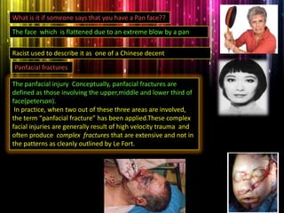 The panfacial injury Conceptually, panfacial fractures are
defined as those involving the upper,middle and lower third of
face(peterson).
In practice, when two out of these three areas are involved,
the term “panfacial fracture” has been applied.These complex
facial injuries are generally result of high velocity trauma and
often produce complex fractures that are extensive and not in
the patterns as cleanly outlined by Le Fort.
What is it if someone says that you have a Pan face??
The face which is flattened due to an extreme blow by a pan
Panfacial fractures
Racist used to describe it as one of a Chinese decent
 
