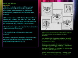 Upper mid face unit:
Central (7)
•After the frontal bar has been stabilized, a rigid
horizontal buttress for fixation of nasoethmoid
fractures has been created and its appropriate
relationship to the anterior cranial base has been
restored.
•Adequate reduction and fixation of the nasoethmoid
complex, the aesthetic core of the face, is the most
important determinant of upper midfacial width and
the most critical step in complex fracture reconst.
•Reconstruction begins with repair of the nasomaxillary
and nasofrontal buttresses.(a)
•The medial orbital walls are then reduced and
repaired
•Transnasal reduction of the medial orbital rims is the
next step and the most important maneuver in
controlling midfacial width).(b),(c )
(a)Sequencing of comminuted nasoethmoid fractures begins
with reconst. of the nasomaxillary and nasofrontal
Buttresses
(b) Transnasal reduct. of the medial orbital rims performed
next, wires are placed a/b the tendons and each is properly
oriented in the a-p plane
(c ) If the medial canthal tendon has been avulsed , it is
suspended from the transnasal wire with (4.0 polypropylene)
suture after rigid fixation of the facial skeleton has been
completed,Incorporating the tendon with the transnasal wire
runs the risk of shredding the tendon.
(d) After medial canthal reconstruction, a cantilever cranial
bone graft is used to rebuild the nasal dorsum(LAST STEP)
(a)
(b)
©
(d)
 