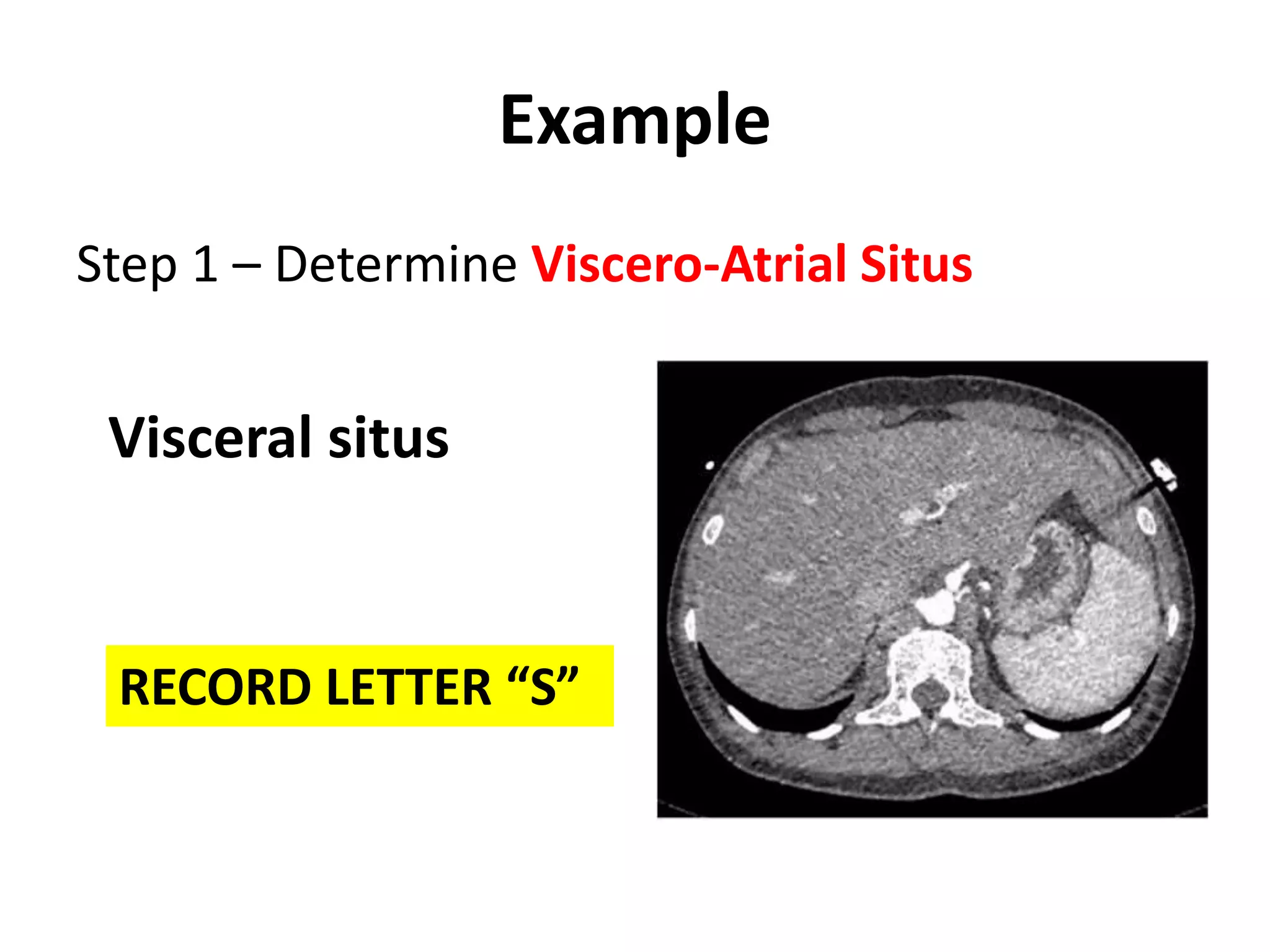 Sequential segmental analysis of heart | PPTX