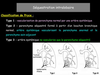 Classification de Pryce :
Type 1 : vascularisation de parenchyme normal par une artère systémique
Type 2 : parenchyme séquestré formé à partir d’un bouchon bronchique
normal, artère systémique vascularisant le parenchyme anormal et le
parenchyme sain adjacent
Type 3 : artère systémique ne vascularise que le parenchyme séquestré
Séquestration intralobaire
 