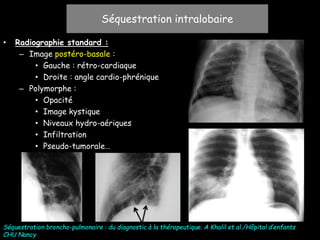 • Radiographie standard :
– Image postéro-basale :
• Gauche : rétro-cardiaque
• Droite : angle cardio-phrénique
– Polymorphe :
• Opacité
• Image kystique
• Niveaux hydro-aériques
• Infiltration
• Pseudo-tumorale…
Séquestration intralobaire
Séquestration broncho-pulmonaire : du diagnostic à la thérapeutique. A Khalil et al./Hôpital d’enfants
CHU Nancy
 