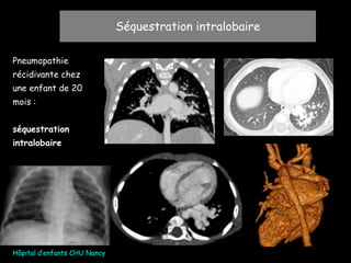 Séquestration intralobaire
Pneumopathie
récidivante chez
une enfant de 20
mois :
séquestration
intralobaire
Hôpital d’enfants CHU Nancy
 