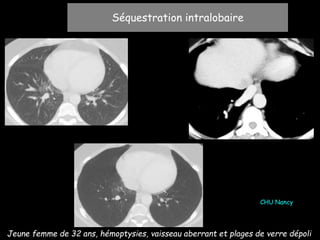 Séquestration intralobaire
Jeune femme de 32 ans, hémoptysies, vaisseau aberrant et plages de verre dépoli
CHU Nancy
 