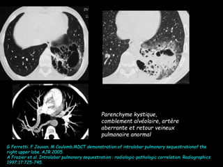 Parenchyme kystique,
comblement alvéolaire, artère
aberrante et retour veineux
pulmonaire anormal
G Ferretti. F Jouvan. M Coulomb.MDCT demonstration of intralobar pulmonary sequestrationof the
right upper lobe. AJR 2005.
A Frazier et al. Intralobar pulmonary sequestration : radiologic-pathologic correlation. Radiographics
1997;17:725-745.
 