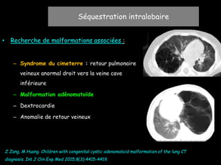 • Recherche de malformations associées :
– Syndrome du cimeterre : retour pulmonaire
veineux anormal droit vers la veine cave
inférieure
– Malformation adénomatoïde
– Dextrocardie
– Anomalie de retour veineux
Séquestration intralobaire
Z Zang, M Huang. Children with congenital cystic adenomatoid malformation of the lung CT
diagnosis. Int J Clin Exp Med 2015;8(3):4415-4419.
 
