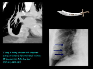 Z Zang, M Huang. Children with congenital
cystic adenomatoid malformation of the lung
CT diagnosis. Int J Clin Exp Med
2015;8(3):4415-4419.
 