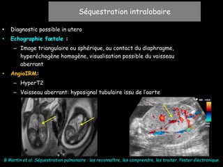 • Diagnostic possible in utero
• Echographie fœtale :
– Image triangulaire ou sphérique, au contact du diaphragme,
hyperéchogène homogène, visualisation possible du vaisseau
aberrant
• AngioIRM:
– HyperT2
– Vaisseau aberrant: hyposignal tubulaire issu de l’aorte
B Martin et al. Séquestration pulmonaire : les reconnaître, les comprendre, les traiter. Poster électronique.
Séquestration intralobaire
 