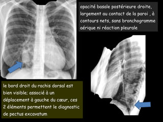 opacité basale postérieure droite,
largement au contact de la paroi , à
contours nets, sans bronchogramme
aérique ni réaction pleurale
le bord droit du rachis dorsal est
bien visible; associé à un
déplacement à gauche du cœur, ces
2 éléments permettent le diagnostic
de pectus excavatum
 