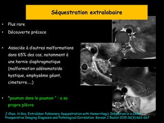 • Plus rare
• Découverte précoce
• Associée à d’autres malformations
dans 65% des cas, notamment à
une hernie diaphragmatique
(malformation adénomatoïde
kystique, emphysème géant,
cimeterre…..)
• "poumon dans le poumon " : a sa
propre plèvre
J Choe, H Goo. Extralobar Pulmonary Sequestration with Hemorrhagic Infarction in a Child:
Preoperative Imaging Diagnosis and Pathological Correlation. Korean J Radiol 2015;16(3):662-667
Séquestration extralobaire
 