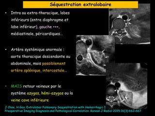 • Intra ou extra-thoracique, lobes
inférieurs (entre diaphragme et
lobe inférieur), gauche +++,
médiastinale, péricardiques…
• Artère systémique anormale :
aorte thoracique descendante ou
abdominale, mais possiblement
artère splénique, intercostale…
• MAIS retour veineux par le
système azygos, hémi-azygos ou la
veine cave inférieure
J Choe, H Goo. Extralobar Pulmonary Sequestration with Hemorrhagic Infarction in a Child:
Preoperative Imaging Diagnosis and Pathological Correlation. Korean J Radiol 2015;16(3):662-667
Séquestration extralobaire
 