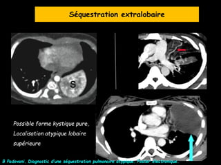 Possible forme kystique pure,
Localisation atypique lobaire
supérieure
B Padovani. Diagnostic d’une séquestration pulmonaire atypique. Poster électronique.
Séquestration extralobaire
 