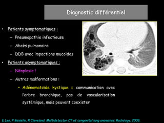 Diagnostic différentiel
E Lee, P Boiselle, R Cleveland. Multidetector CT of congenital lung anomalies. Radiology. 2008.
• Patients symptomatiques :
– Pneumopathie infectieuse
– Abcès pulmonaire
– DDB avec impactions mucoïdes
• Patients asymptomatiques :
– Néoplasie !
– Autres malformations :
• Adénomatoïde kystique = communication avec
l’arbre bronchique, pas de vascularisation
systémique, mais peuvent coexister
 