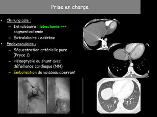 • Chirurgicale :
– Intralobaire : lobectomie +++,
segmentectomie
– Extralobaire : exérèse
• Endovasculaire :
– Séquestration artérielle pure
(Pryce 1)
– Hémoptysie ou shunt avec
défaillance cardiaque (NN)
– Embolisation du vaisseau aberrant
Prise en charge
 