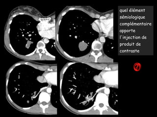 quel élément
sémiologique
complémentaire
apporte
l'injection de
produit de
contraste
 