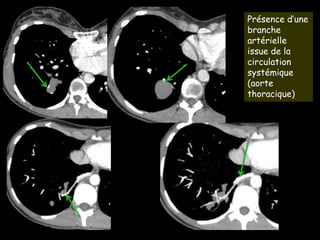 Présence d’une
branche
artérielle
issue de la
circulation
systémique
(aorte
thoracique)
 