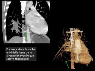Présence d’une branche
artérielle issue de la
circulation systémique
(aorte thoracique)
 