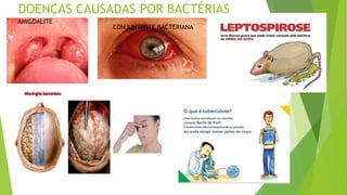 DOENÇAS CAUSADAS POR BACTÉRIAS
AMIGDALITE
CONJUNTIVITE BACTERIANA
 
