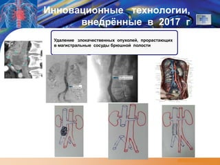 LOGO
www.themegallery.com
Инновационные технологии,
внедрённые в 2017 г
2002
2001
2000
Удаление злокачественных опухолей, прорастающих
в магистральные сосуды брюшной полости
2005
2004
2003
 