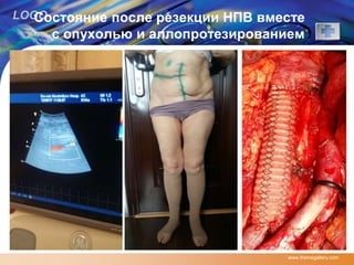 LOGOСостояние после резекции НПВ вместе
с опухолью и аллопротезированием
www.themegallery.com
 