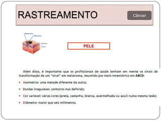 RASTREAMENTO    Câncer




         PELE
 
