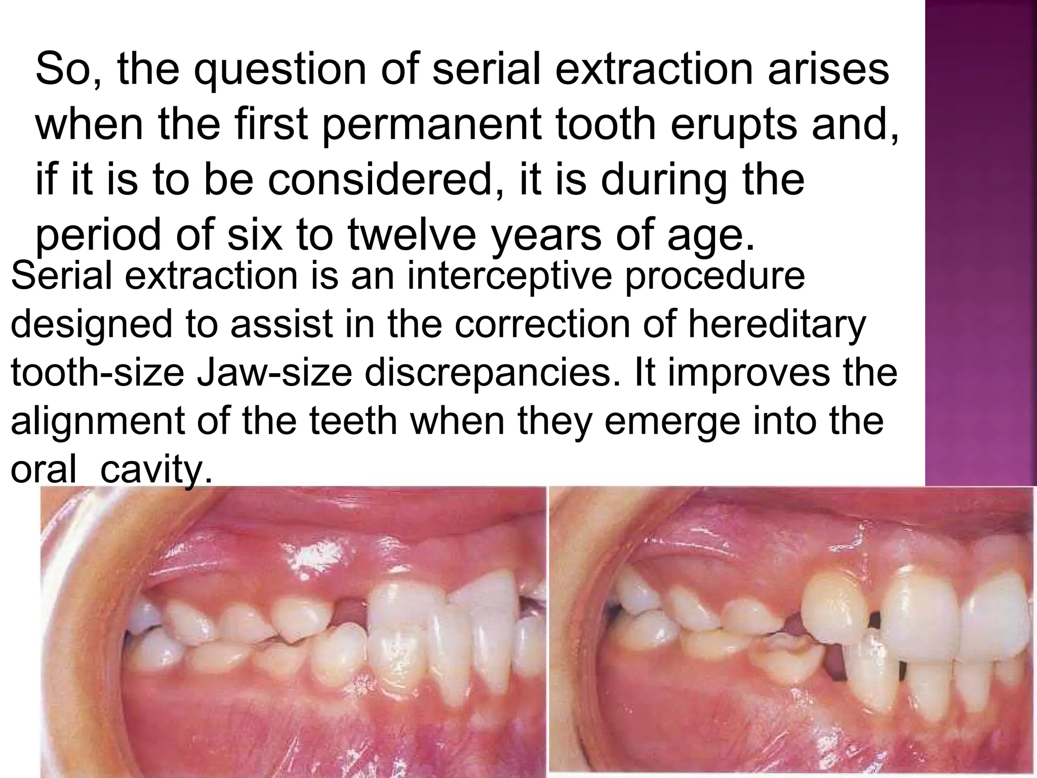 Serial extraction in orthodontic | PPT