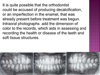 Serial Extraction Definition Serial extraction in orthodontic | PPT