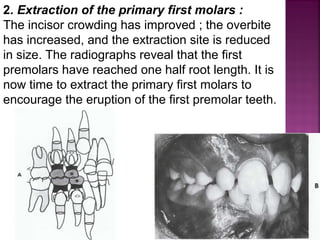 Serial extraction in orthodontic | PPT