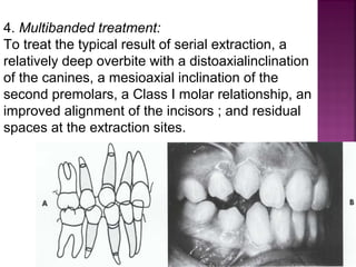Serial extraction in orthodontic | PPT