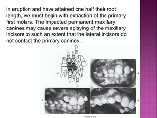 Serial extraction in orthodontic | PPT
