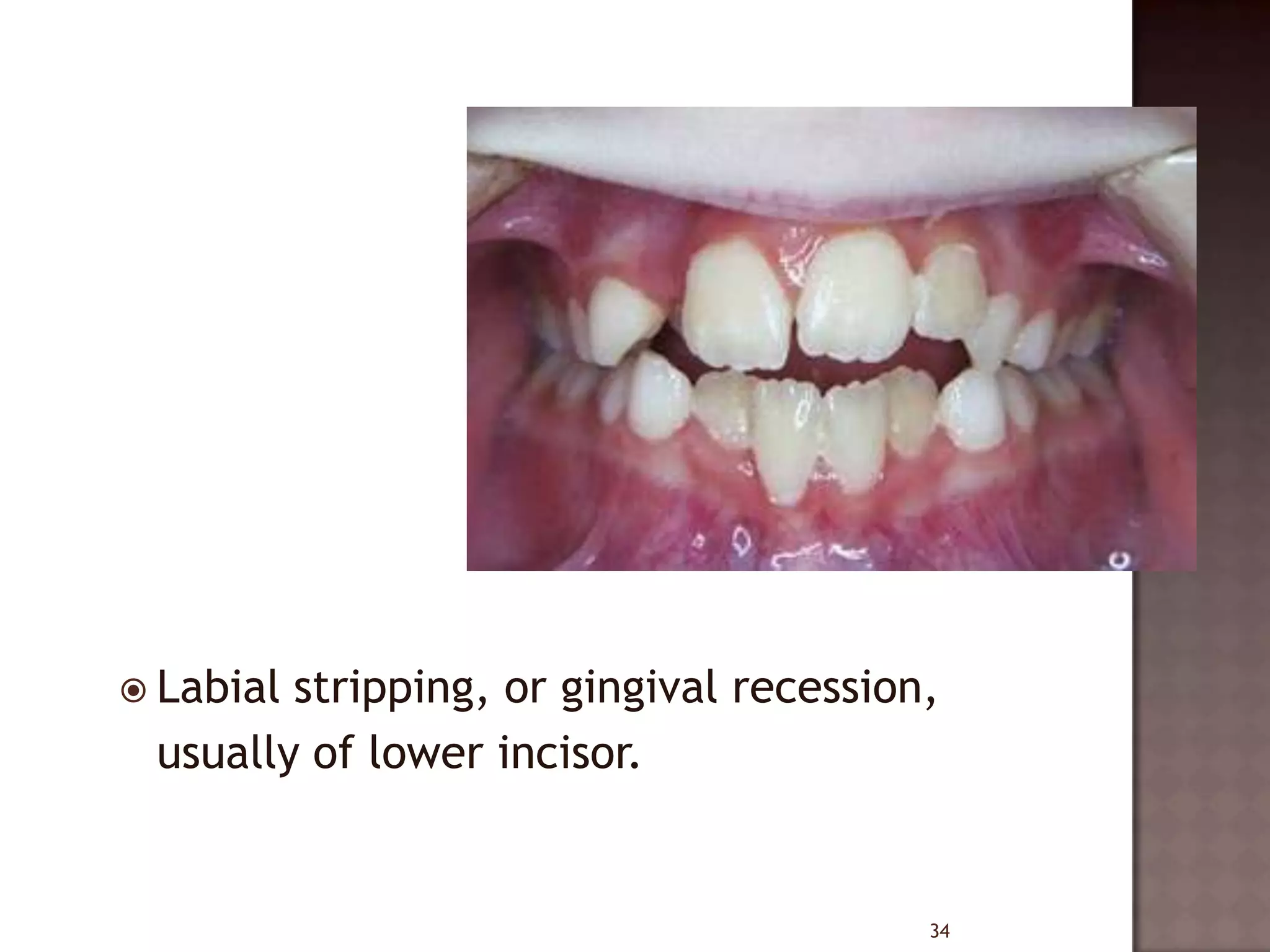 Serial extraction | PPTX