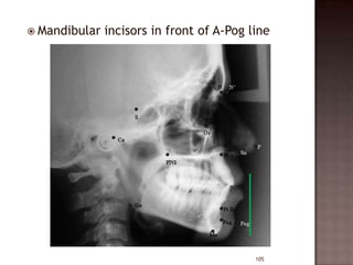  Mandibular

incisors in front of A-Pog line

105

 