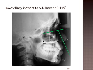  Maxillary

incisors to S-N line: 110-115˚

106

 