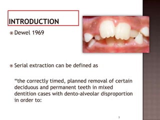  Dewel



1969

Serial extraction can be defined as
“the correctly timed, planned removal of certain
deciduous and permanent teeth in mixed
dentition cases with dento-alveolar disproportion
in order to:
3

 