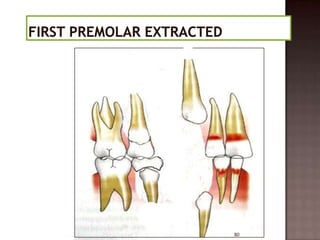 Serial extraction | PPTX