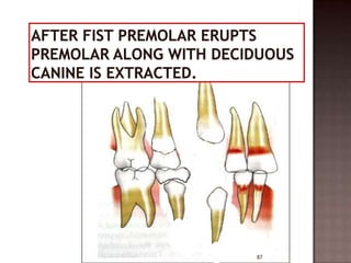 Serial extraction | PPTX