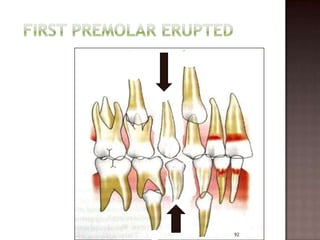 Serial extraction | PPTX