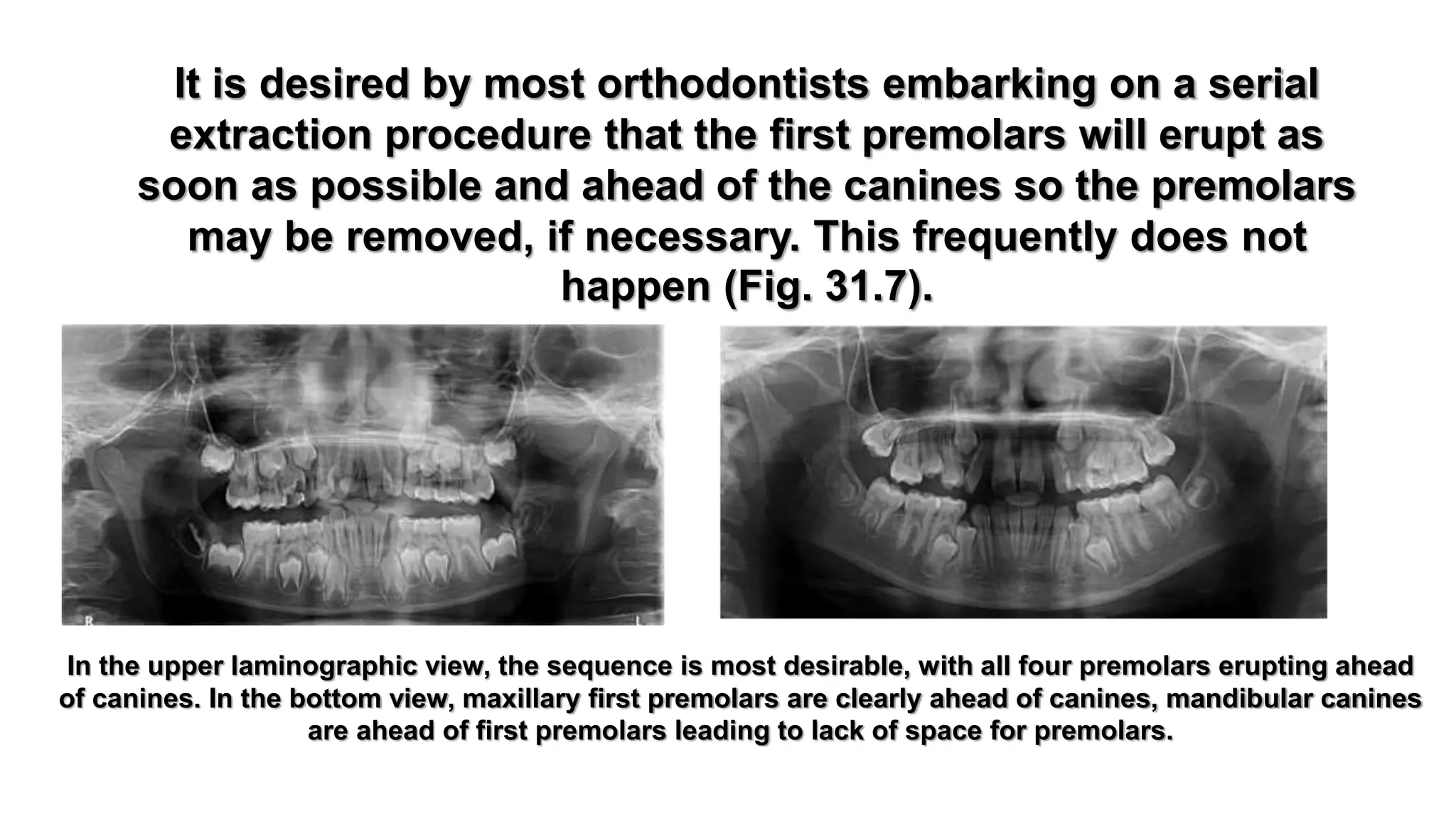 Serial extraction of class i malocclusion | PPTX