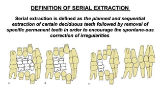 Serial extraction of class i malocclusion | PPTX